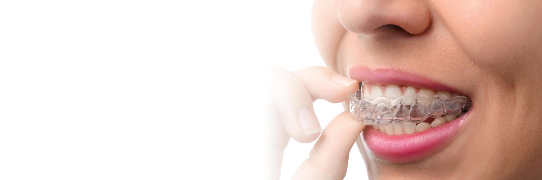 Invisalign® Clear Aligners | Clinician